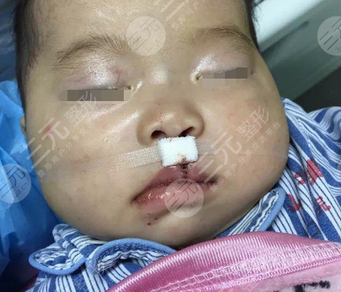 兔唇整形需要多少钱