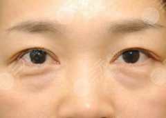 眼袋和黑眼圈的区别对比，眼袋和黑眼圈应该怎样去除？