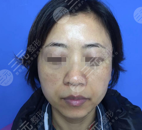 激光去黄褐斑的优势及注意事项解析