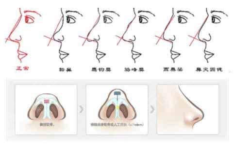如何改良大鼻头？干货：4个有改良大鼻头的方法