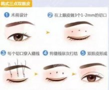 微创三点双眼皮手术科普！变美攻略&亲身体验分享，电眼get！
