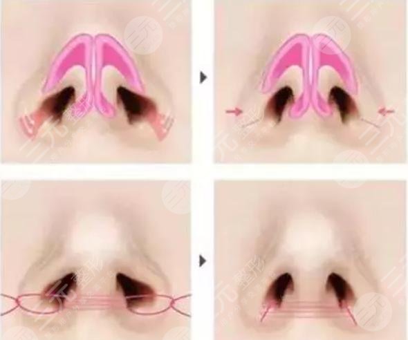 鼻头鼻翼鼻尖整形恢复期多久？科普&果图分享，攻略来袭！