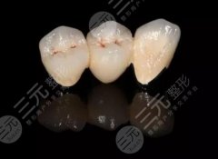 钴铬烤瓷牙的价格一般多少钱？修复牙齿别怕贵，牙好吃饭香！