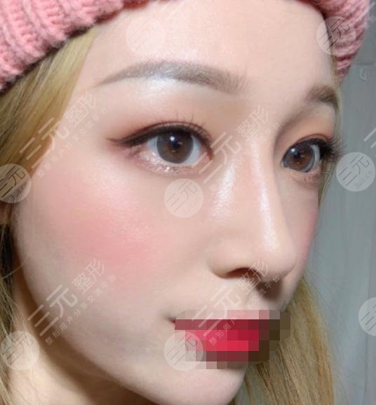 小姐姐注射隆鼻后4个月