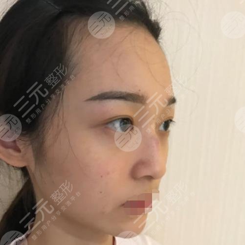 小姐姐注射隆鼻前