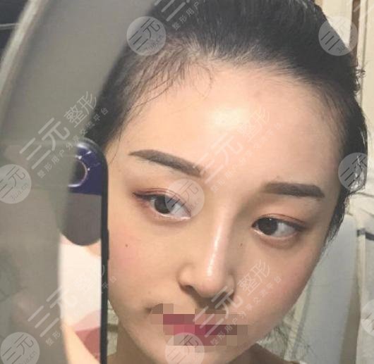 小姐姐注射隆鼻后半个月