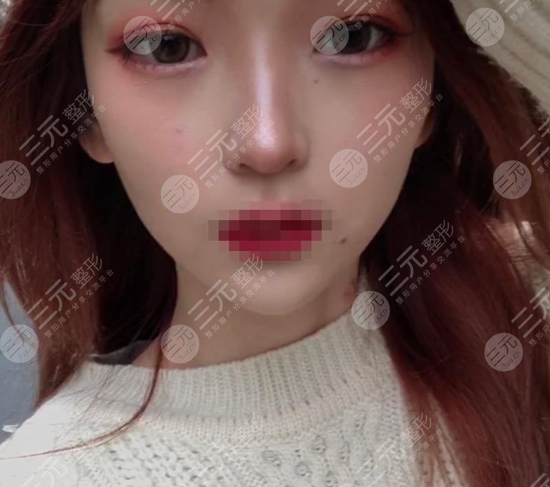 玻尿酸丰太阳穴后1个月