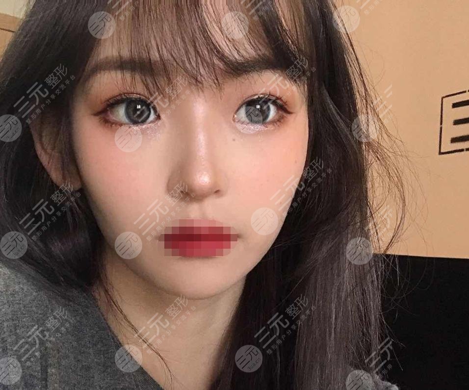 玻尿酸丰太阳穴后4个月