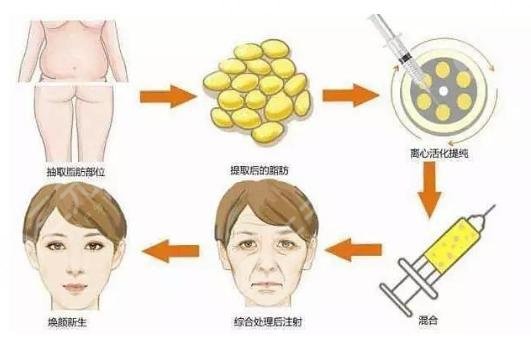 自体脂肪面部填充