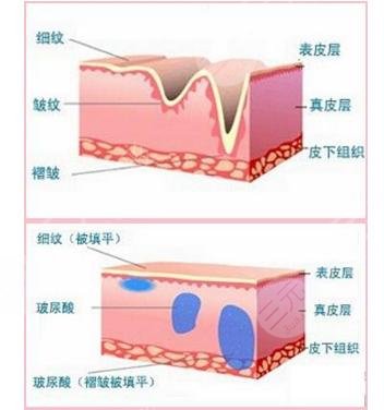 玻尿酸除皱