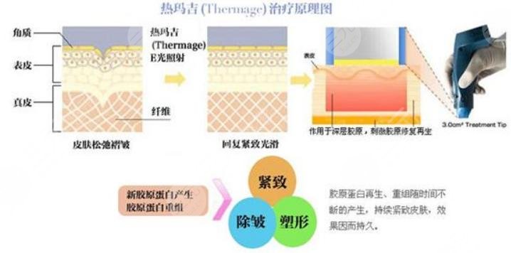 热玛吉
