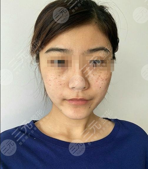 黑脸娃娃嫩肤后半个月