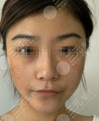 黑脸娃娃嫩肤前