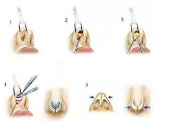 硅胶和膨体的价钱