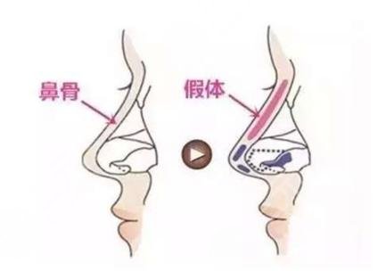 硅胶和膨体的区别是什么