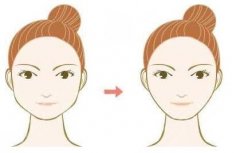 下颌角磨骨术多少钱？恢复过程图分享，揭秘ta是否值得花钱！