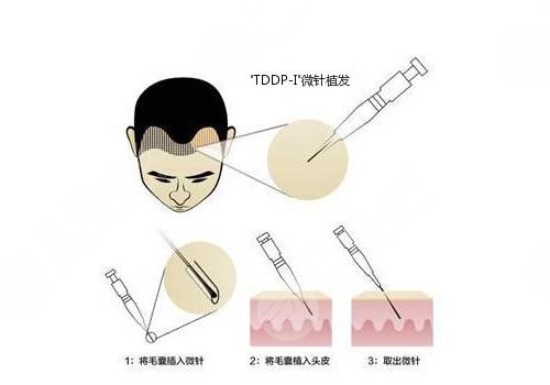 cgf缓解脱发价格参考！手术原理&注意事项贴心科普！