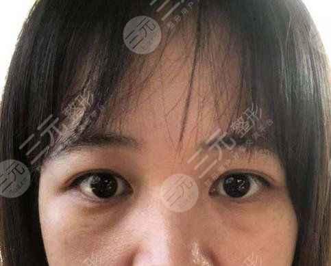 昆明丽都整形医院去眼袋案例