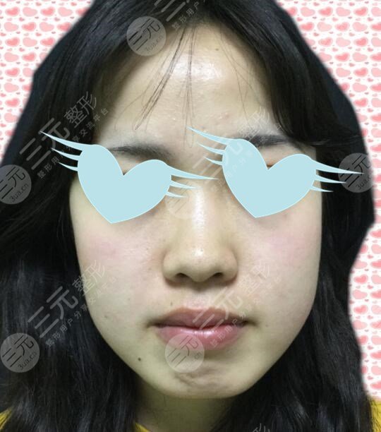注射隆鼻前