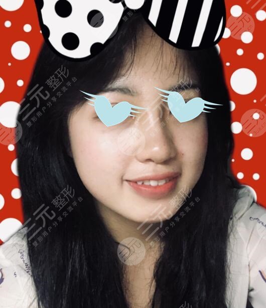 注射隆鼻后