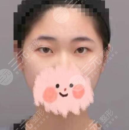 双眼皮术前