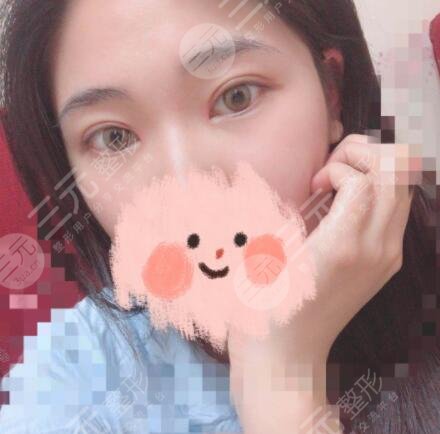 双眼皮术后45天