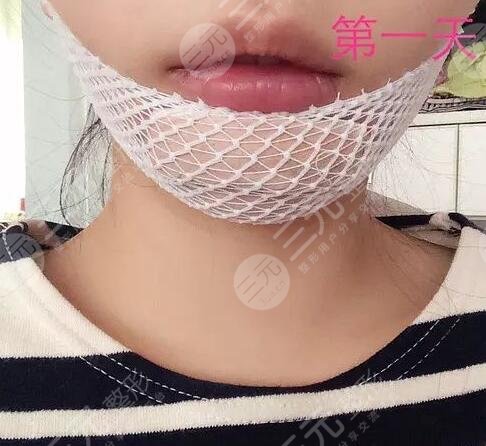 真人垫下巴后1天