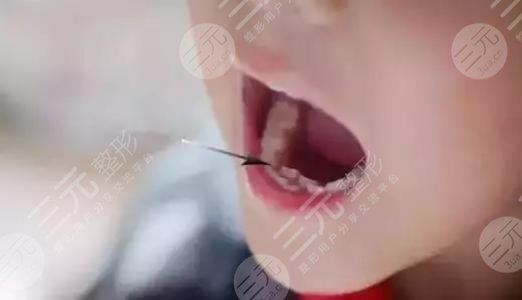 乳牙滞留怎么办