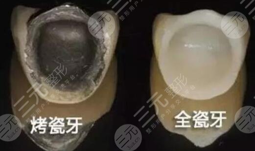 做烤瓷牙有什么后遗症