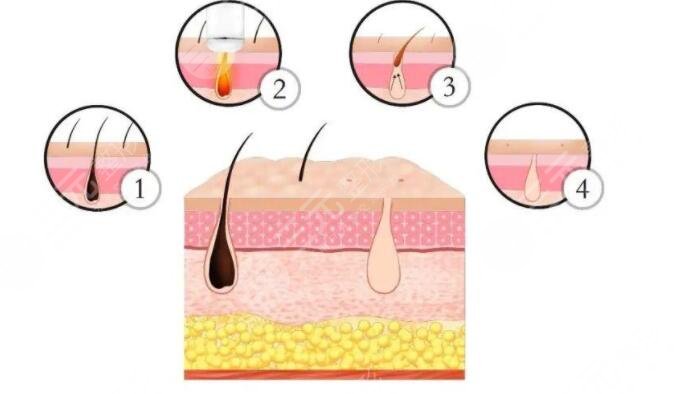 什么是冰点脱毛
