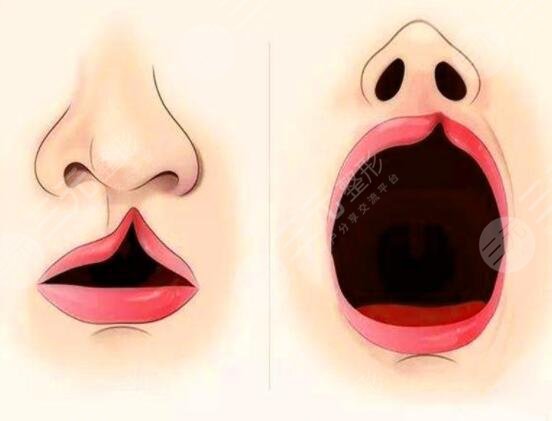 兔唇整形方法