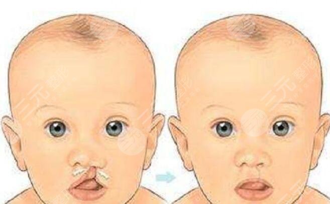 兔唇整形术后的注意事项