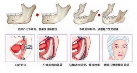 什么是下颌角切除