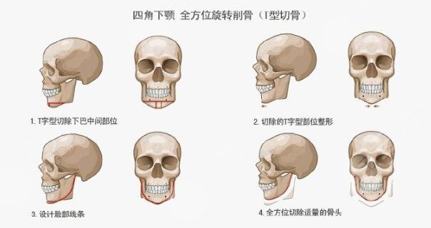 下颌角切除费用一般多少钱