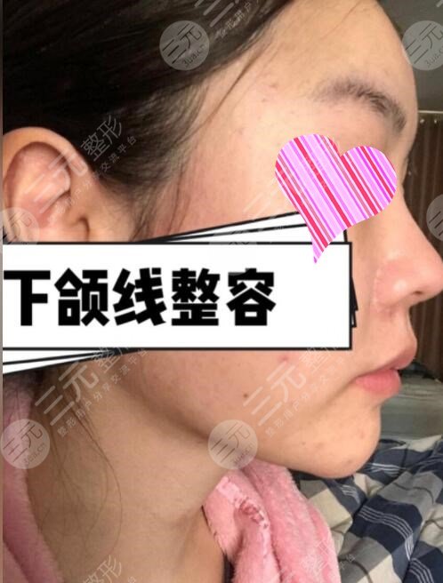 下颌角手术前