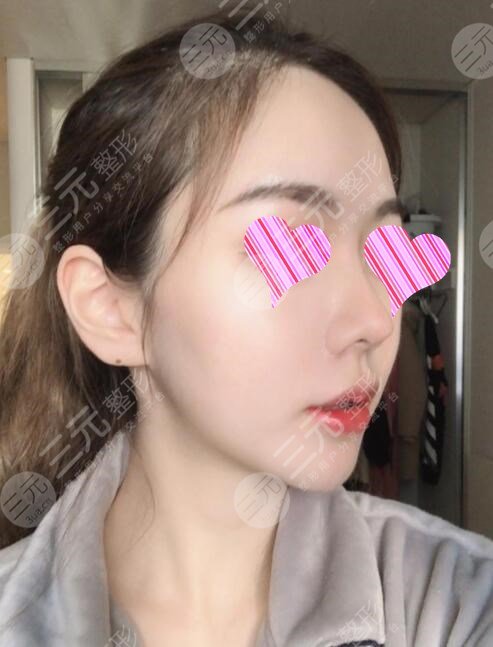 下颌角手术后