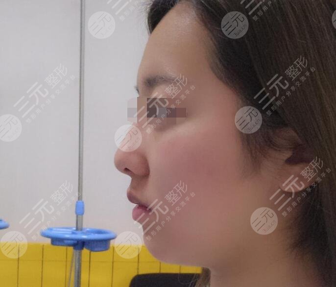 自体脂肪丰下巴前