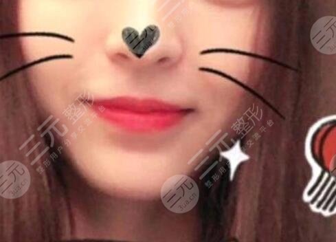 自体脂肪丰下巴后一个月