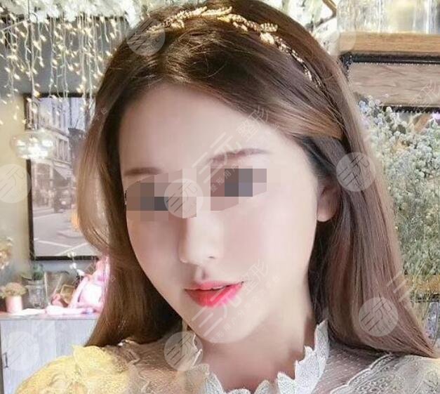 自体脂肪丰下巴后4个月