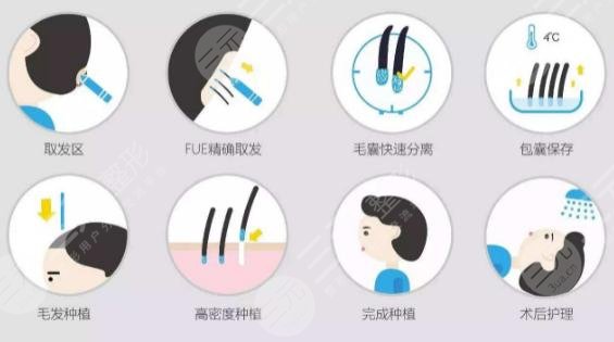 植发技术究竟是什么