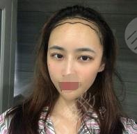 真人植发前