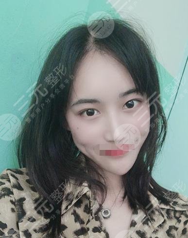 真人植发后5个月