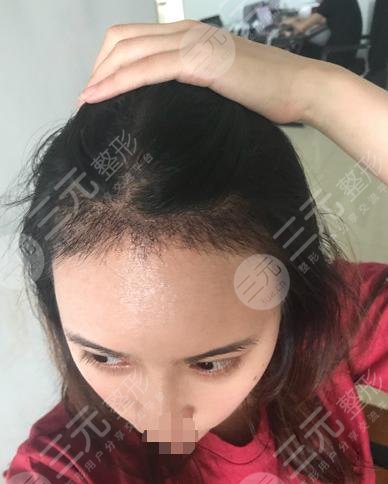 真人植发后3个月