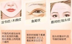 自体脂肪去皱纹怎么样?用“多余”的补充“失去”的,科普讲解! 自体脂肪去皱纹怎么样?用“多余”的补充“失去”的,科普讲解!
