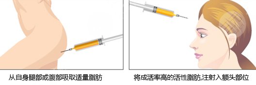 自体脂肪去皱纹