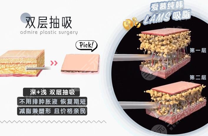 赵军舰吸脂怎么样