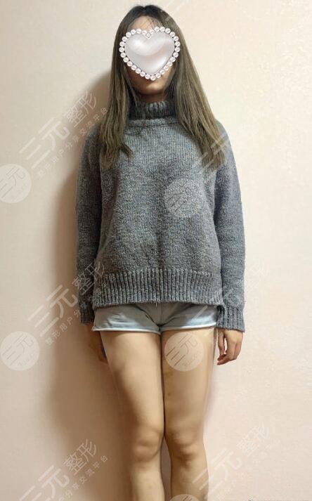 赵军舰医生吸脂案例分享