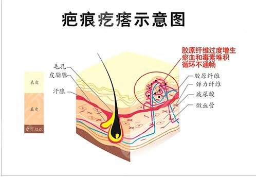 像素激光去除疤痕色素沉着的解决方法