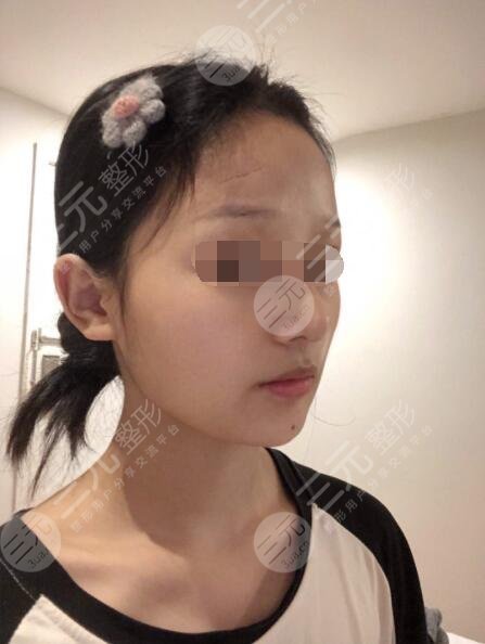 像素激光祛疤后4个月