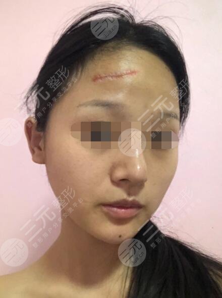 像素激光祛疤前